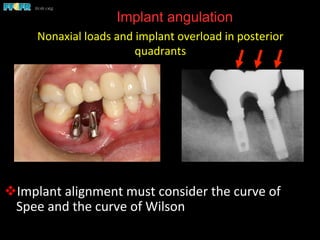 Implant angulation
v Implant	
  alignment	
  must	
  consider	
  the	
  curve	
  of	
  
Spee	
  and	
  the	
  curve	
  of	
  Wilson	
  
Nonaxial	
  loads	
  and	
  implant	
  overload	
  in	
  posterior	
  
quadrants	
  
 
