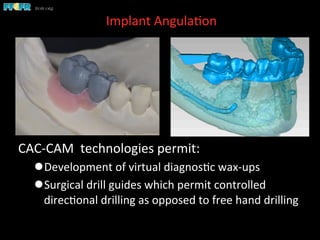Implant	
  Angula(on	
  	
  
CAC-­‐CAM	
  	
  technologies	
  permit:	
  
l Development	
  of	
  virtual	
  diagnos(c	
  wax-­‐ups	
  
l Surgical	
  drill	
  guides	
  which	
  permit	
  controlled	
  
direc(onal	
  drilling	
  as	
  opposed	
  to	
  free	
  hand	
  drilling	
  
 