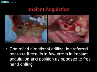Implant	
  Angula(on	
  	
  
•  Controlled directional drilling is preferred
because it results in few errors in implant
angulation and position as opposed to free
hand drilling
 