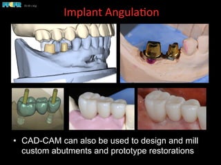 Implant	
  Angula(on	
  	
  
•  CAD-CAM can also be used to design and mill
custom abutments and prototype restorations
 