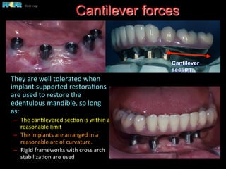  They	
  are	
  well	
  tolerated	
  when	
  
implant	
  supported	
  restora(ons	
  
are	
  used	
  to	
  restore	
  the	
  
edentulous	
  mandible,	
  so	
  long	
  
as:	
  
–  The	
  can(levered	
  sec(on	
  is	
  within	
  a	
  
reasonable	
  limit	
  
–  The	
  implants	
  are	
  arranged	
  in	
  a	
  
reasonable	
  arc	
  of	
  curvature.	
  
–  Rigid	
  frameworks	
  with	
  cross	
  arch	
  
stabiliza(on	
  are	
  used	
  
Cantilever forces
Cantilever
section
 