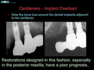 Cantilevers – Implant Overload
•  Note the bone loss around the dental implants adjacent
to the cantilever.
Restorations designed in this fashion, especially
in the posterior maxilla, have a poor prognosis.
 