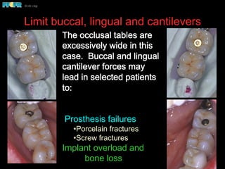Limit buccal, lingual and cantilevers
The occlusal tables are
excessively wide in this
case. Buccal and lingual
cantilever forces may
lead in selected patients
to:
Prosthesis failures
• Porcelain fractures
• Screw fractures
Implant overload and
bone loss
 