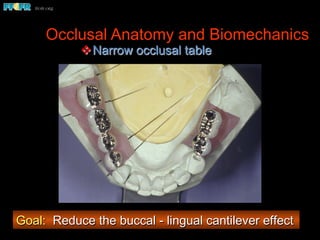 Occlusal Anatomy and Biomechanics
v Narrow occlusal table
Goal: Reduce the buccal - lingual cantilever effect
 