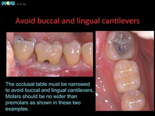 Avoid	
  buccal	
  and	
  lingual	
  can(levers	
  	
  
The occlusal table must be narrowed
to avoid buccal and lingual cantilevers.
Molars should be no wider than
premolars as shown in these two
examples.
 