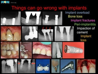 Things can go wrong with implants
Biomechanics – Partially Edentulous Patients
!  Because of the curve of Spee and the distal angulation of the implants, the
occlusal loads (arrow) are nonaxial.
!  Note the bone loss around the implants. Linear configurations in the posterior
region, such as in this patient, are particularly vulnerable to the effects of
nonaxial loading, particularly brachycephalic individuals.
Nonaxial loads and implant overload in posterior
quadrants
Semi-precision attachments
usion of the natural tooth abutment
ears after delivery the patient noticed the premolar
o intrude. Exam revealed that the screw retaining the
ad become loose, hence the rotation of this crown.
Bruxism - Case Report
This is a five year followup x-ray of
a patient with an implant
supported fixed partial denture.
Closer exam revealed
both implants to be
fractured .
The patient was a heavy bruxer.
Six months later he presented
with significant bone loss around
both implants.
Bruxism - Case Report
This is a five year followup x-ray of
a patient with an implant
supported fixed partial denture.
The patient was a heavy bruxer.
Six months later he presented
with significant bone loss around
both implants.
Implant overload
Bone loss
Implant fractures
Peri-implantitis
Impaction of
cement
Implant
loss
 