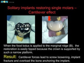 Solitary implants restoring single molars –
Cantilever effect
When the food bolus is applied to the marginal ridge (B), the
restoration is easily tipped because the crown is supported by
such a narrow platform.
Result: Cantilever forces lead to screw loosening, implant
fracture and overload the bone anchoring the implant.
BA
 