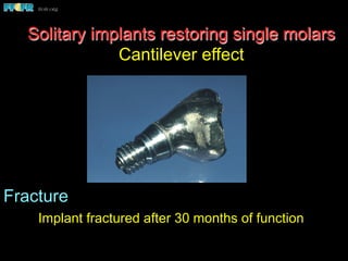 Fracture
Implant fractured after 30 months of function
Solitary implants restoring single molars
Cantilever effect
 