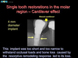Single tooth restorations in the molar
region – Cantilever effect
This implant was too short and too narrow to
withstand occlusal loads and bone loss caused by
the resorptive remodeling response led to its loss.
4 mm
diameter
implant
Mesial	
  canClever	
  
 