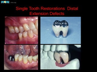 Single Tooth Restorations Distal
Extension Defects
 