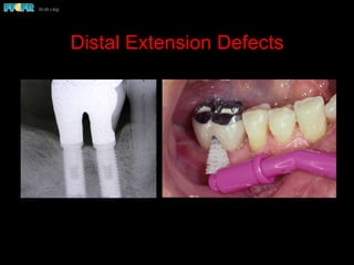 Distal Extension Defects
 