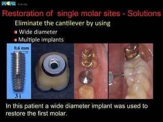 Restoration of single molar sites - Solutions
In this patient a wide diameter implant was used to
restore the first molar.
	
  Eliminate	
  the	
  can(lever	
  by	
  using	
  
 	
  Wide	
  diameter	
  
 	
  Mul(ple	
  implants	
  
 