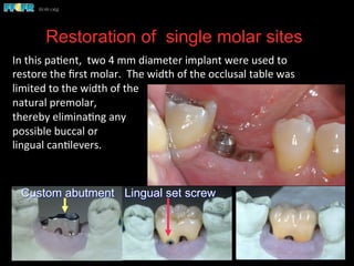Restoration of single molar sites
Custom abutment Lingual set screw
In	
  this	
  pa(ent,	
  	
  two	
  4	
  mm	
  diameter	
  implant	
  were	
  used	
  to	
  
restore	
  the	
  ﬁrst	
  molar.	
  	
  The	
  width	
  of	
  the	
  occlusal	
  table	
  was	
  
limited	
  to	
  the	
  width	
  of	
  the	
  
natural	
  premolar,	
  	
  
thereby	
  elimina(ng	
  any	
  
possible	
  buccal	
  or	
  	
  
lingual	
  can(levers.	
  
 