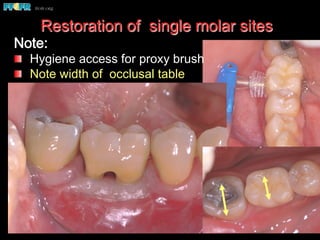 Restoration of single molar sites
Note:
  Hygiene access for proxy brush
  Note width of occlusal table
 