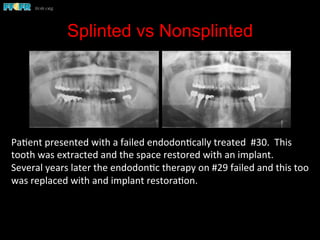 Splinted vs Nonsplinted
Pa(ent	
  presented	
  with	
  a	
  failed	
  endodon(cally	
  treated	
  	
  #30.	
  	
  This	
  
tooth	
  was	
  extracted	
  and	
  the	
  space	
  restored	
  with	
  an	
  implant.	
  	
  
Several	
  years	
  later	
  the	
  endodon(c	
  therapy	
  on	
  #29	
  failed	
  and	
  this	
  too	
  
was	
  replaced	
  with	
  and	
  implant	
  restora(on.	
  	
  	
  
 