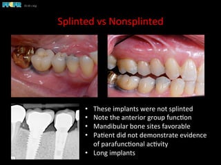Splinted	
  vs	
  Nonsplinted	
  
•  These	
  implants	
  were	
  not	
  splinted	
  
•  Note	
  the	
  anterior	
  group	
  func(on	
  
•  Mandibular	
  bone	
  sites	
  favorable	
  
•  Pa(ent	
  did	
  not	
  demonstrate	
  evidence	
  
of	
  parafunc(onal	
  ac(vity	
  
•  Long	
  implants	
  
 