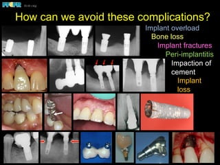 How can we avoid these complications?
Biomechanics – Partially Edentulous Patients
!  Because of the curve of Spee and the distal angulation of the implants, the
occlusal loads (arrow) are nonaxial.
!  Note the bone loss around the implants. Linear configurations in the posterior
region, such as in this patient, are particularly vulnerable to the effects of
nonaxial loading, particularly brachycephalic individuals.
Nonaxial loads and implant overload in posterior
quadrants
Semi-precision attachments
usion of the natural tooth abutment
ears after delivery the patient noticed the premolar
o intrude. Exam revealed that the screw retaining the
ad become loose, hence the rotation of this crown.
Bruxism - Case Report
This is a five year followup x-ray of
a patient with an implant
supported fixed partial denture.
Closer exam revealed
both implants to be
fractured .
The patient was a heavy bruxer.
Six months later he presented
with significant bone loss around
both implants.
Bruxism - Case Report
This is a five year followup x-ray of
a patient with an implant
supported fixed partial denture.
The patient was a heavy bruxer.
Six months later he presented
with significant bone loss around
both implants.
Implant overload
Bone loss
Implant fractures
Peri-implantitis
Impaction of
cement
Implant
loss
 