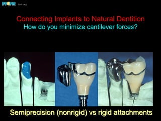 Connecting Implants to Natural Dentition
How do you minimize cantilever forces?
Semiprecision (nonrigid) vs rigid attachments
 