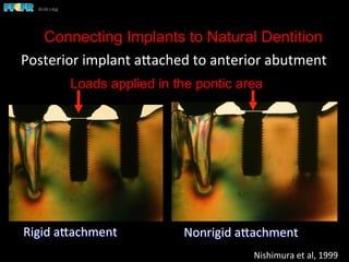Connecting Implants to Natural Dentition
Posterior	
  implant	
  apached	
  to	
  anterior	
  abutment	
  
Rigid	
  apachment	
  
	
  
Nonrigid	
  apachment	
  
Nishimura	
  et	
  al,	
  1999	
  
Loads applied in the pontic area
 