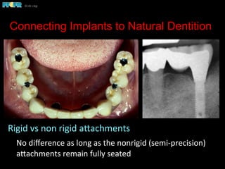 Connecting Implants to Natural Dentition
Rigid	
  vs	
  non	
  rigid	
  apachments	
  
	
  No	
  diﬀerence	
  as	
  long	
  as	
  the	
  nonrigid	
  (semi-­‐precision)	
  
apachments	
  remain	
  fully	
  seated	
  	
  
 