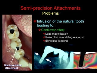 Semi-precision Attachments
Problems
v Intrusion of the natural tooth
leading to:
v Cantilever affect
v Load magnification
v Resorptive remodeling response
v Bone loss (arrows)
Semi-precision
attachment
 