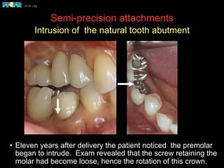 Semi-precision attachments
Intrusion of the natural tooth abutment
•  Eleven years after delivery the patient noticed the premolar
began to intrude. Exam revealed that the screw retaining the
molar had become loose, hence the rotation of this crown.
 