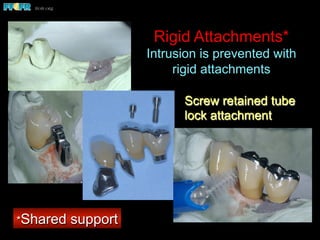 Rigid Attachments*
Intrusion is prevented with
rigid attachments
Screw retained tube
lock attachment
*Shared support
 