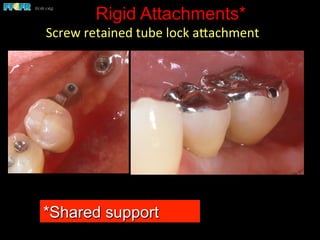 Rigid Attachments*
Screw	
  retained	
  tube	
  lock	
  apachment	
  
*Shared support
 