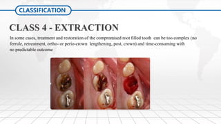Tooth Case Classification Restoration of the Endodontically Treated Tooth (1 & 2) | PDF