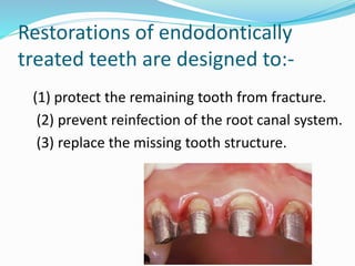 Restoration of the endodontically treated tooth | PPTX
