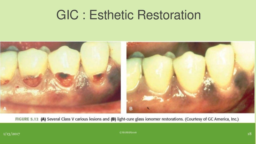 Restorative materials in dental caries