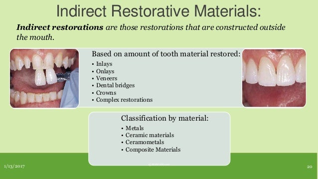 Direct vs indirect dental restoration, Indirect Restorations
