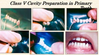 Restorative Materials in pediatric dentistry.pptx