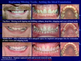 dayanorthodontics.com Bottom Row:  Implant replaced teeth and several restored teeth. Top Row:  Missing teeth tipping and drifting, collapse, deep bite, chipping and wear of front teeth. Middle Row:  After orthodontics, have adequate space for implants and proper bite for restoration of other worn and chipping teeth. Replacing Missing Teeth:  Setting the Ideal Foundation Case continued on next slide 