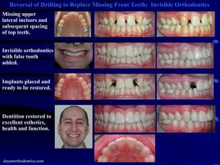 Reversal of Drifting to Replace Missing Front Teeth:  Invisible Orthodontics dayanorthodontics.com Missing upper lateral incisors and subsequent spacing of top teeth. Invisible orthodontics with false tooth added. Implants placed and ready to be restored. Dentition restored to excellent esthetics, health and function. 