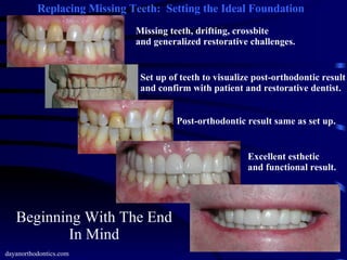 Beginning With The End In Mind dayanorthodontics.com Replacing Missing Teeth:  Setting the Ideal Foundation Missing teeth, drifting, crossbite and generalized restorative challenges. Set up of teeth to visualize post-orthodontic result and confirm with patient and restorative dentist. Post-orthodontic result same as set up. Excellent esthetic and functional result. 
