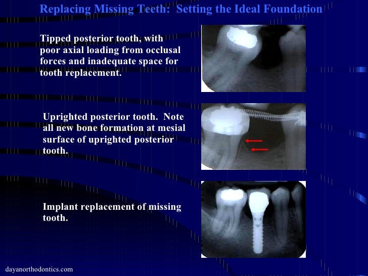 Restoring Missing Teeth & Collapsed Bite