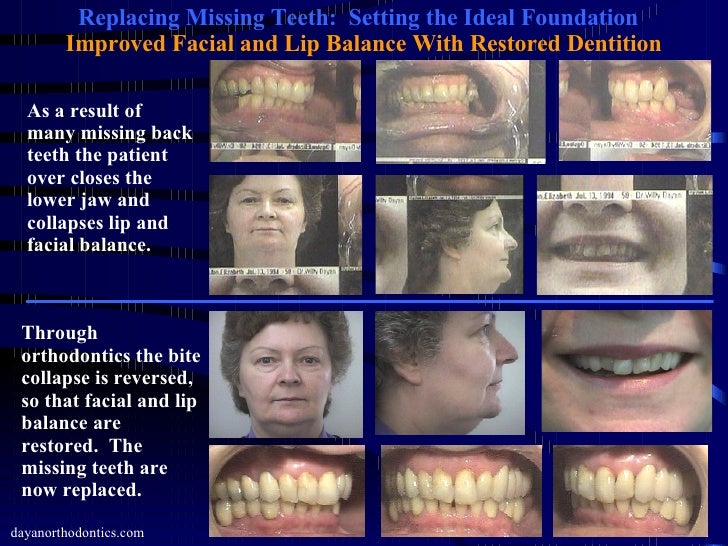 Restoring Missing Teeth & Collapsed Bite