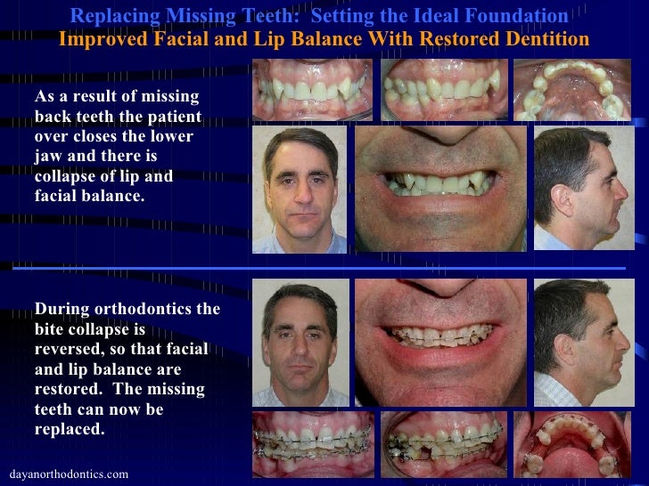 Restoring Missing Teeth & Collapsed Bite