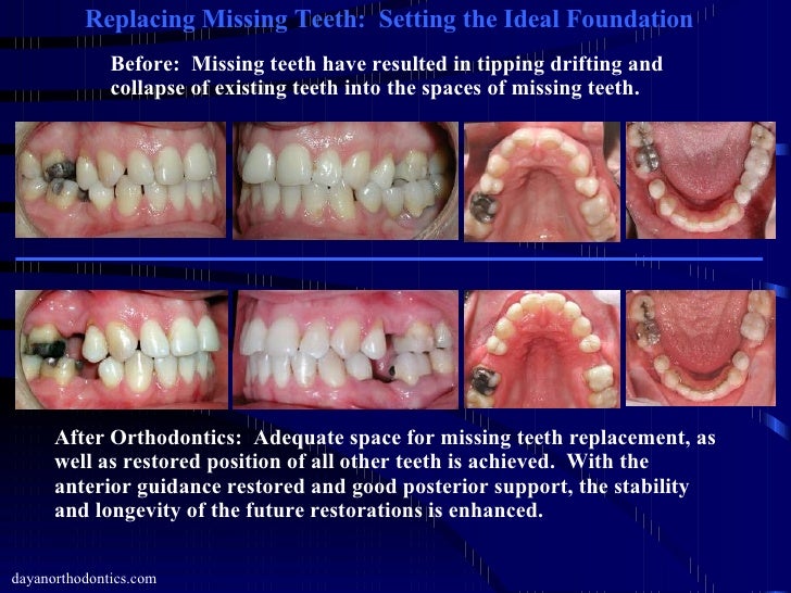 Restoring Missing Teeth & Collapsed Bite