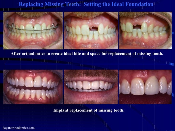teeth setting