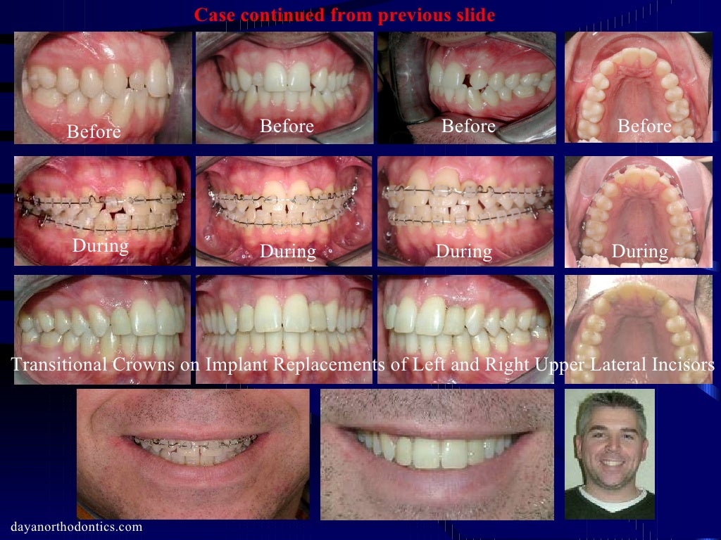 Restoring Missing Teeth & Collapsed Bite