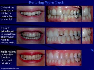 Restoring Worn, Chipped & Broken Teeth | PPT