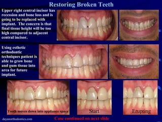 Restoring Worn, Chipped & Broken Teeth PPT
