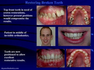 Restoring Worn, Chipped & Broken Teeth PPT
