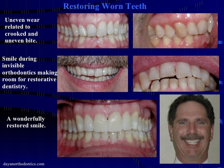 Restoring Worn, Chipped & Broken Teeth