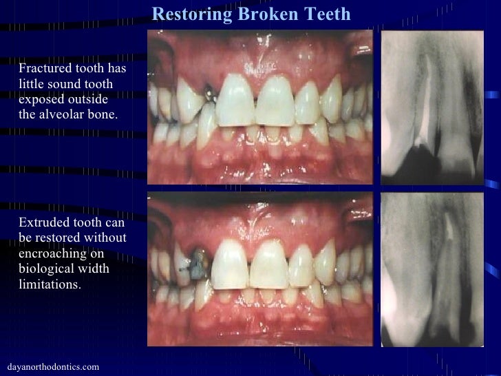 Restoring Worn, Chipped & Broken Teeth