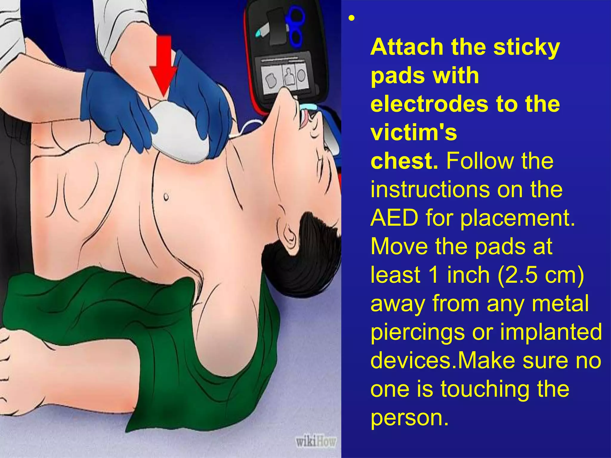 • 
Attach the sticky 
pads with 
electrodes to the 
victim's 
chest. Follow the 
instructions on the 
AED for placement. 
Move the pads at 
least 1 inch (2.5 cm) 
away from any metal 
piercings or implanted 
devices.Make sure no 
one is touching the 
person. 
 