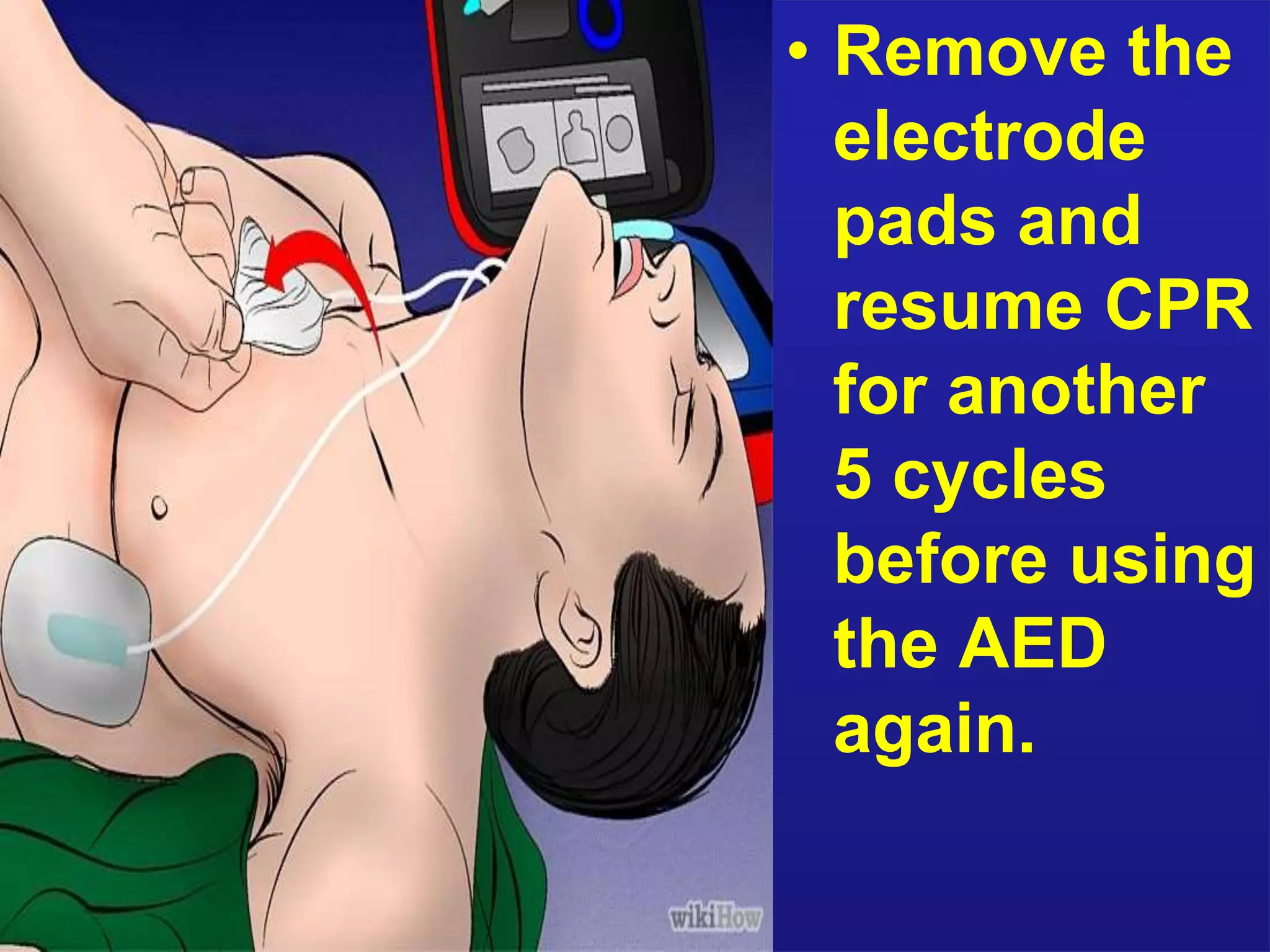 • Remove the 
electrode 
pads and 
resume CPR 
for another 
5 cycles 
before using 
the AED 
again. 
 