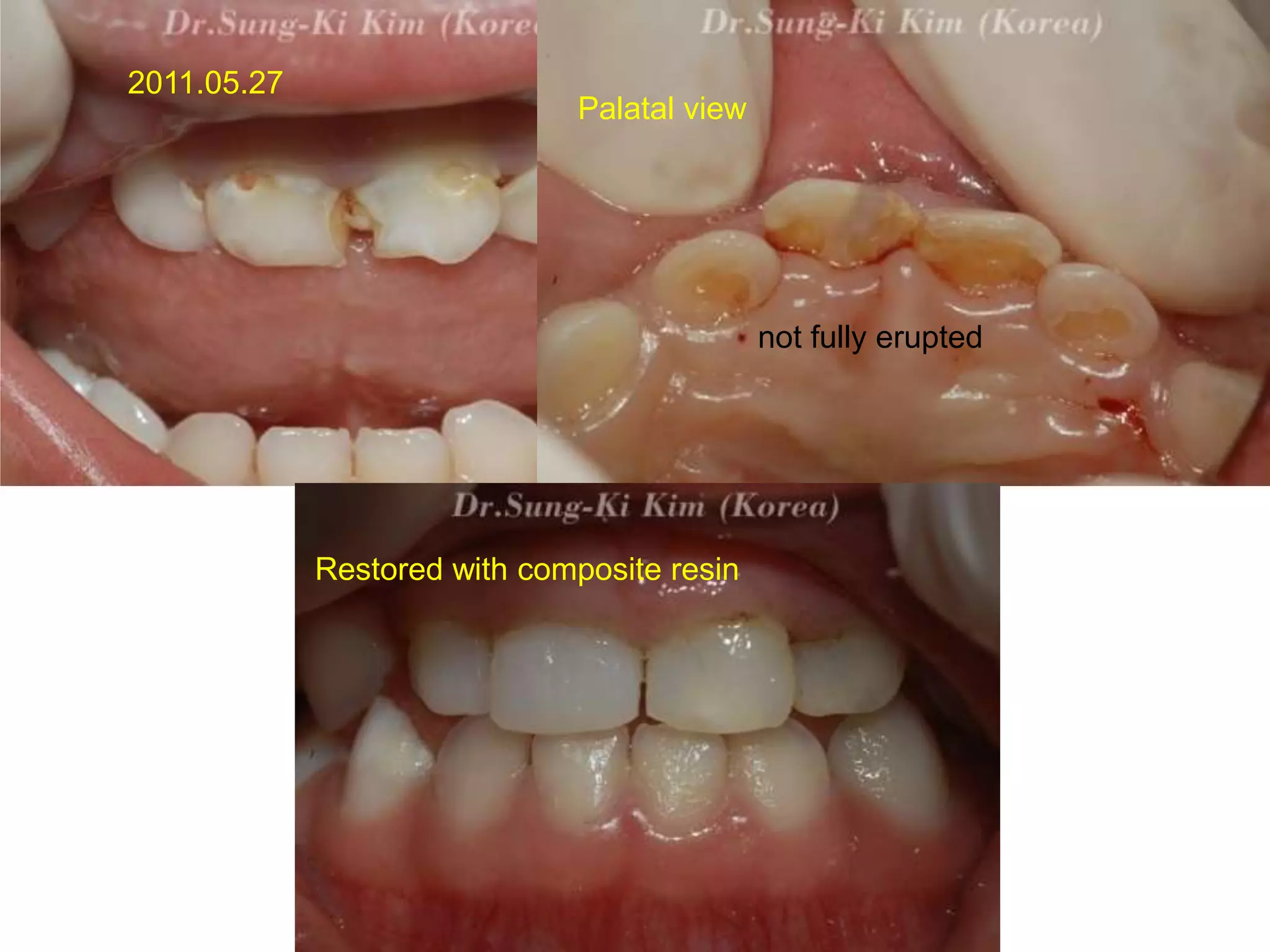 Restoring primary anterior teeth with esthetic crowns | PPTX
